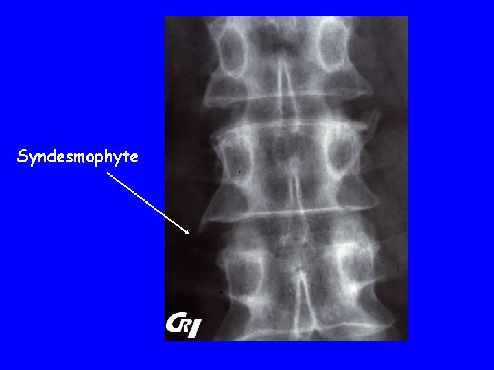 Syndesmophyte 