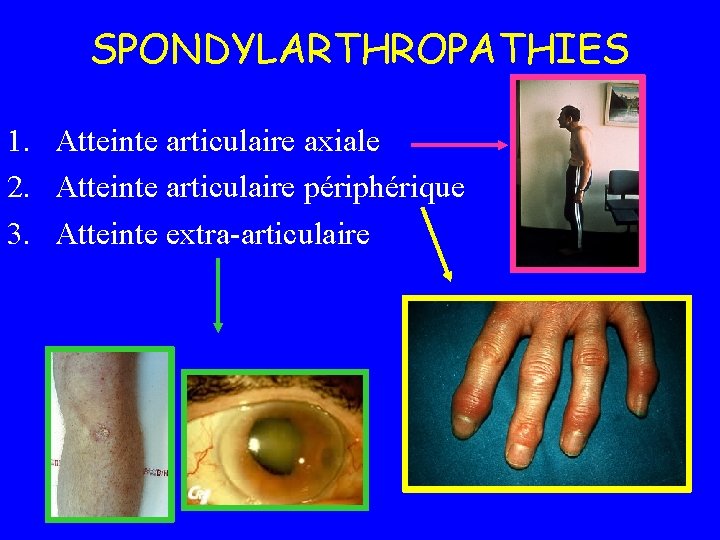 SPONDYLARTHROPATHIES 1. Atteinte articulaire axiale 2. Atteinte articulaire périphérique 3. Atteinte extra-articulaire 