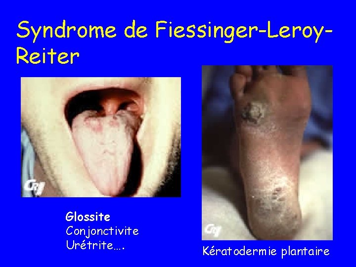 Syndrome de Fiessinger-Leroy. Reiter Glossite Conjonctivite Urétrite…. Kératodermie plantaire 