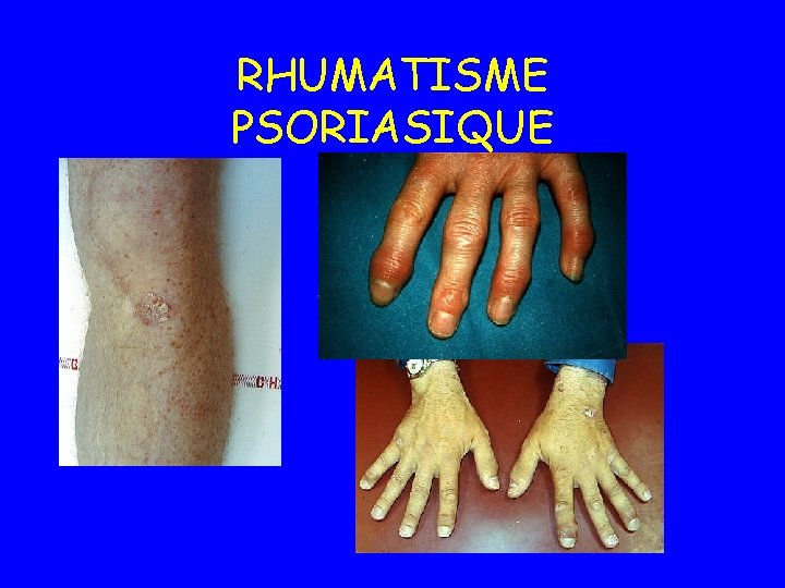 RHUMATISME PSORIASIQUE 