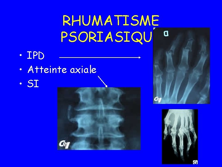 RHUMATISME PSORIASIQUE • IPD • Atteinte axiale • SI 