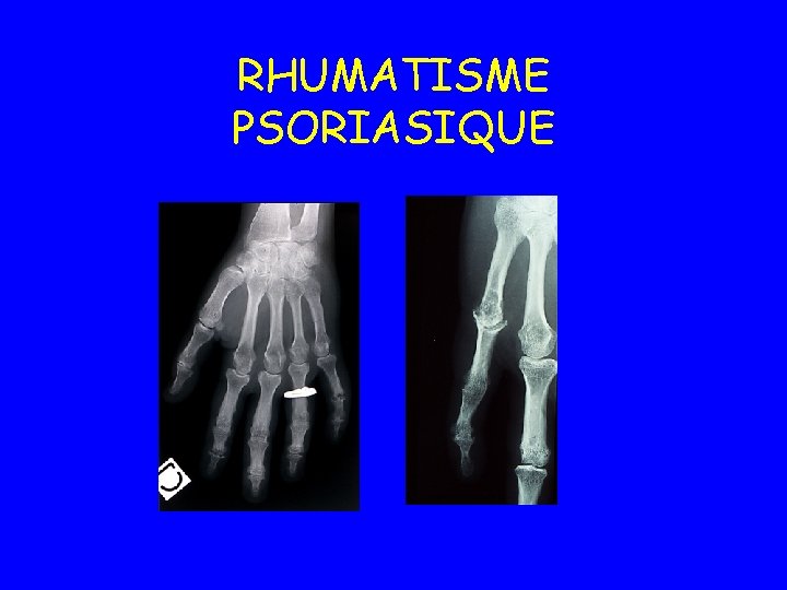 RHUMATISME PSORIASIQUE 