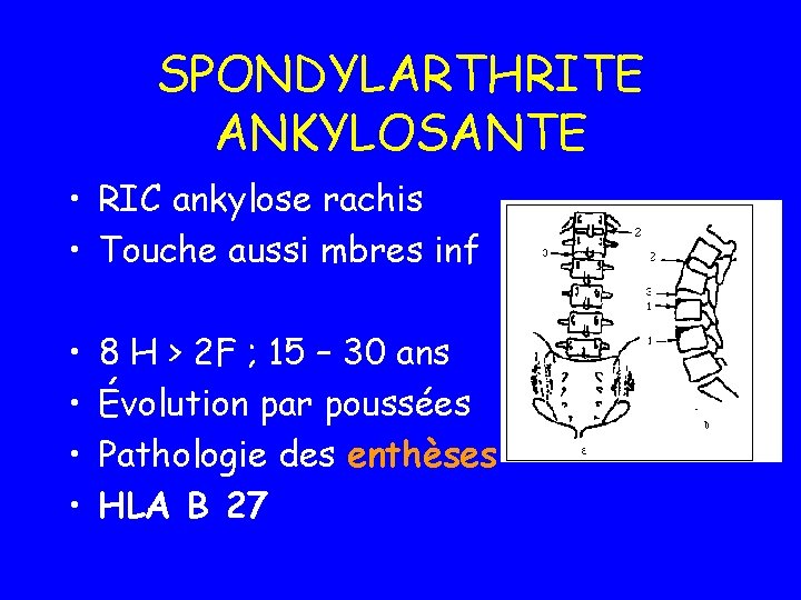 SPONDYLARTHRITE ANKYLOSANTE • RIC ankylose rachis • Touche aussi mbres inf • • 8