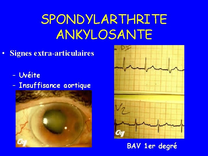 SPONDYLARTHRITE ANKYLOSANTE • Signes extra-articulaires – Uvéite – Insuffisance aortique BAV 1 er degré