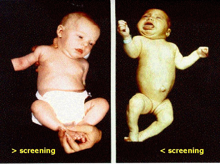 Newborn Screening > screening < screening 