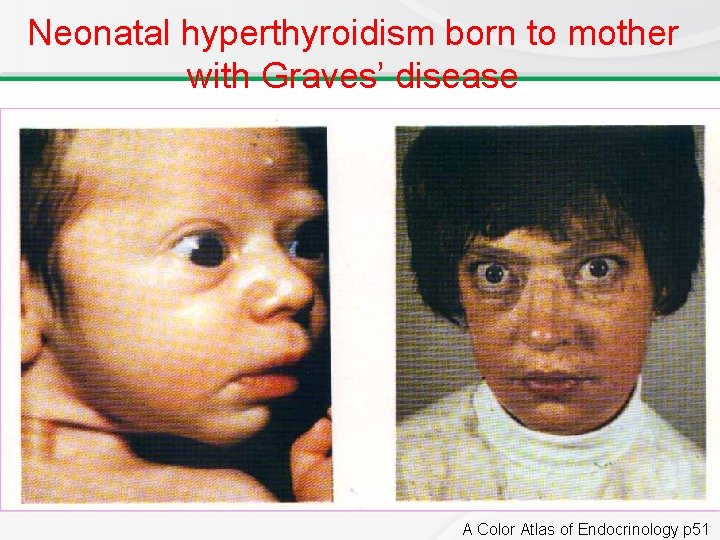 Neonatal hyperthyroidism born to mother with Graves’ disease A Color Atlas of Endocrinology p