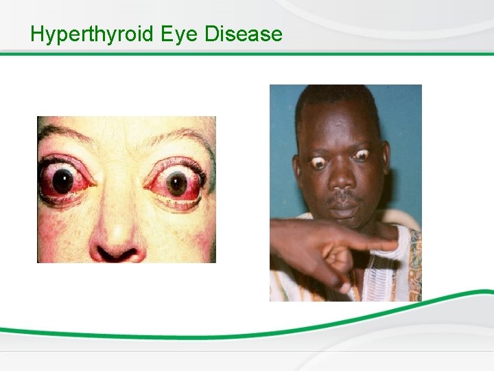 Hyperthyroid Eye Disease 