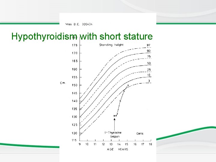 Hypothyroidism with short stature 