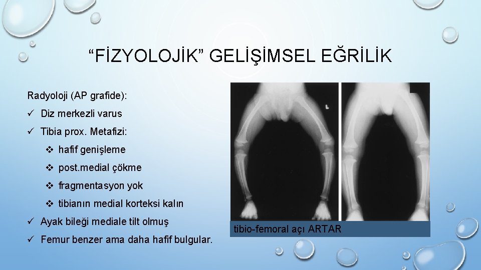 “FİZYOLOJİK” GELİŞİMSEL EĞRİLİK Radyoloji (AP grafide): ü Diz merkezli varus ü Tibia prox. Metafizi: