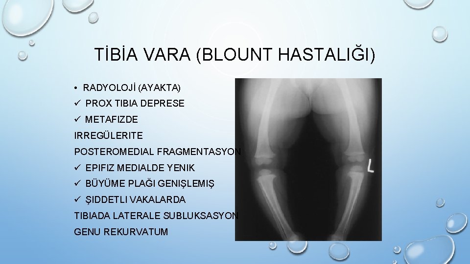 TİBİA VARA (BLOUNT HASTALIĞI) • RADYOLOJİ (AYAKTA) ü PROX TIBIA DEPRESE ü METAFIZDE IRREGÜLERITE TİBİA VARA (BLOUNT HASTALIĞI) • RADYOLOJİ (AYAKTA) ü PROX TIBIA DEPRESE ü METAFIZDE IRREGÜLERITE
