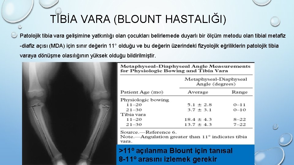 TİBİA VARA (BLOUNT HASTALIĞI) Patolojik tibia vara gelişimine yatkınlığı olan çocukları belirlemede duyarlı bir