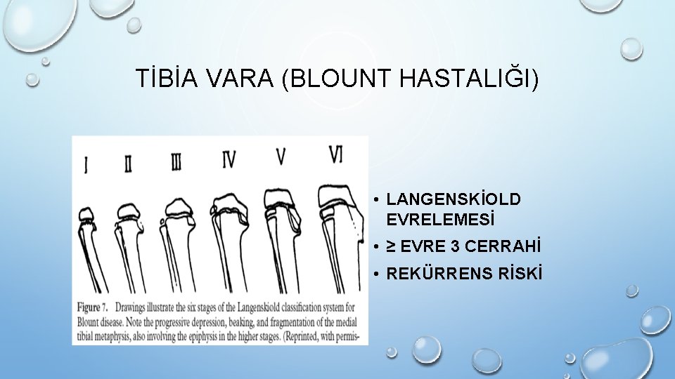 TİBİA VARA (BLOUNT HASTALIĞI) • LANGENSKİOLD EVRELEMESİ • ≥ EVRE 3 CERRAHİ • REKÜRRENS