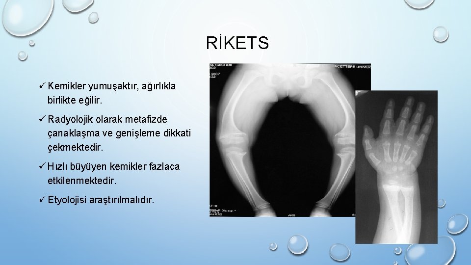 RİKETS ü Kemikler yumuşaktır, ağırlıkla birlikte eğilir. ü Radyolojik olarak metafizde çanaklaşma ve genişleme