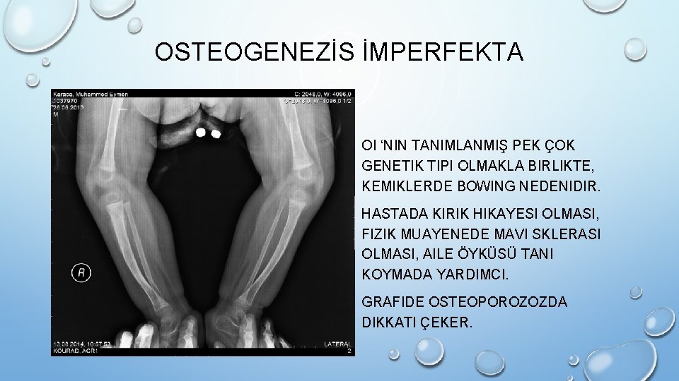 OSTEOGENEZİS İMPERFEKTA • OI ‘NIN TANIMLANMIŞ PEK ÇOK GENETIK TIPI OLMAKLA BIRLIKTE, KEMIKLERDE BOWING