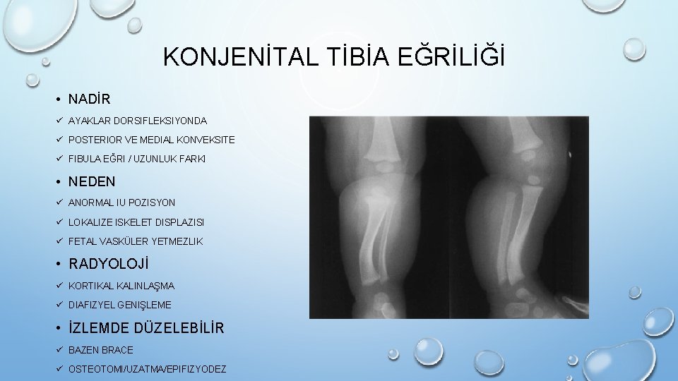 KONJENİTAL TİBİA EĞRİLİĞİ • NADİR ü AYAKLAR DORSIFLEKSIYONDA ü POSTERIOR VE MEDIAL KONVEKSITE ü