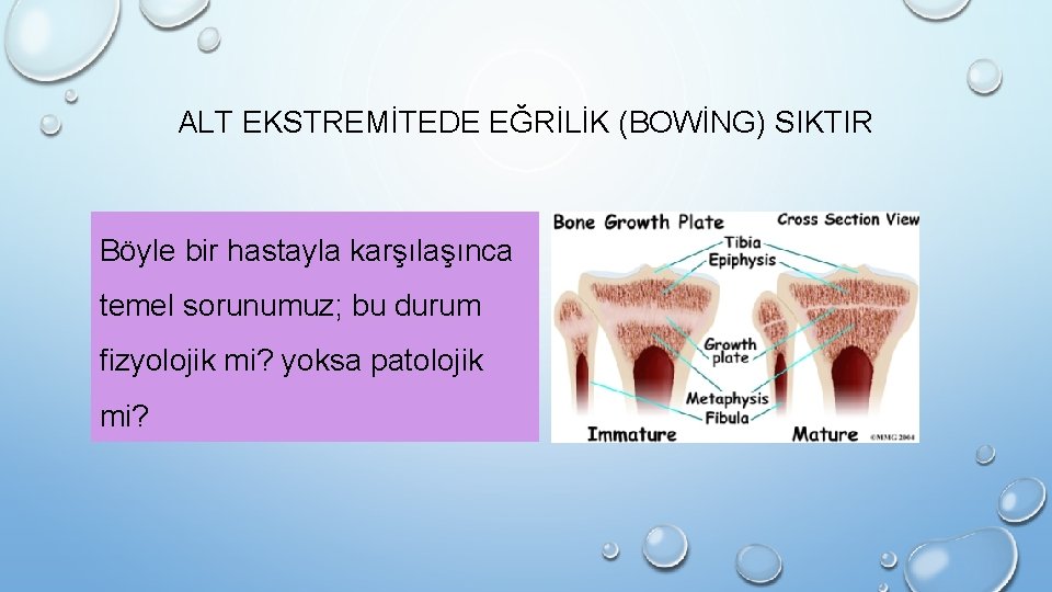 ALT EKSTREMİTEDE EĞRİLİK (BOWİNG) SIKTIR Böyle bir hastayla karşılaşınca temel sorunumuz; bu durum fizyolojik