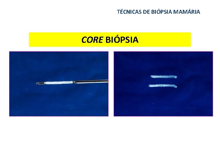 TÉCNICAS DE BIÓPSIA MAMÁRIA CORE BIÓPSIA 