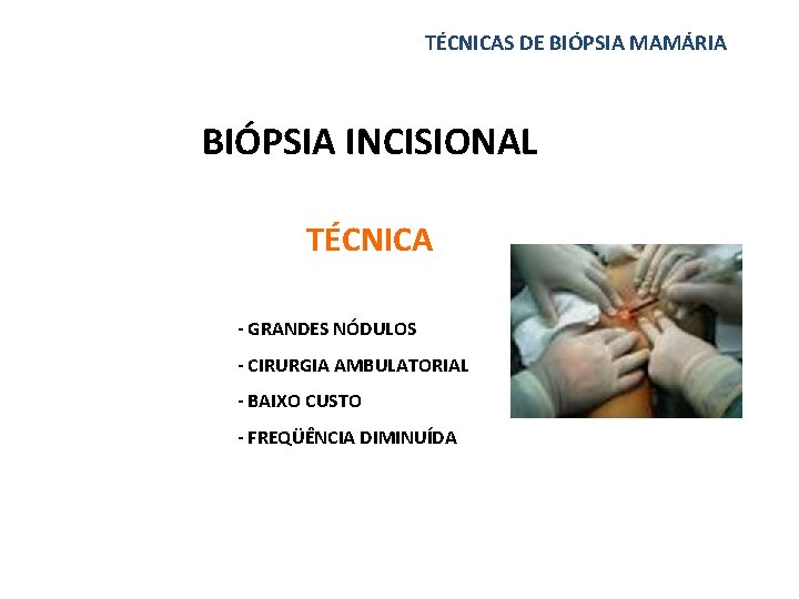 TÉCNICAS DE BIÓPSIA MAMÁRIA BIÓPSIA INCISIONAL TÉCNICA - GRANDES NÓDULOS - CIRURGIA AMBULATORIAL -