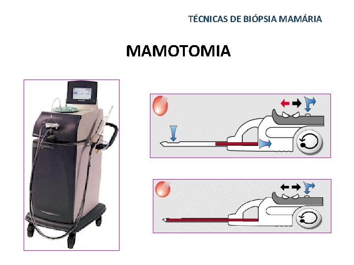 TÉCNICAS DE BIÓPSIA MAMÁRIA MAMOTOMIA 