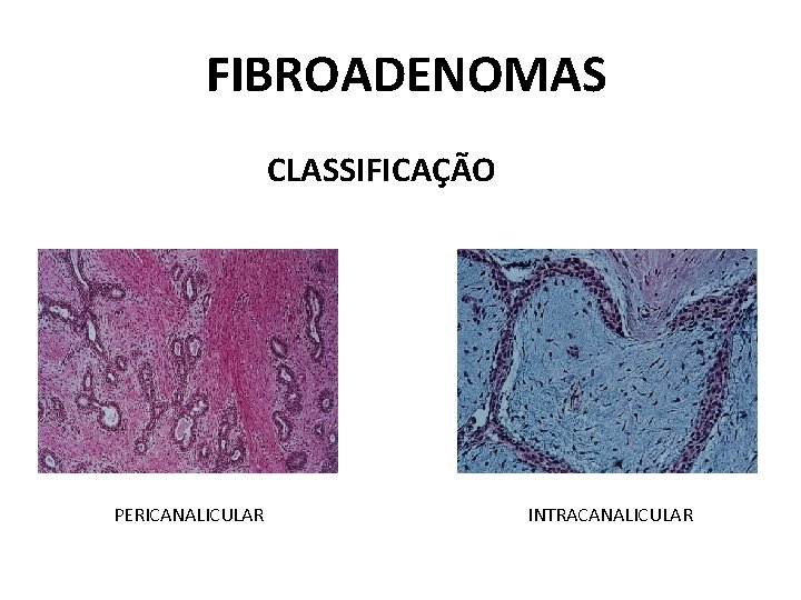 FIBROADENOMAS CLASSIFICAÇÃO PERICANALICULAR INTRACANALICULAR 