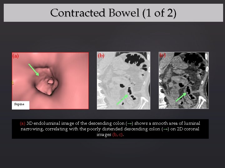 CT Colonography Improving Interpretive Skill by Avoiding Pitfalls