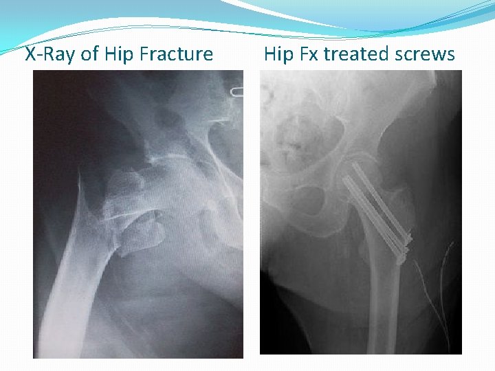 X-Ray of Hip Fracture Hip Fx treated screws 