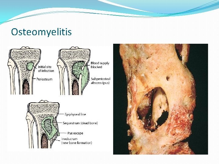 Osteomyelitis 