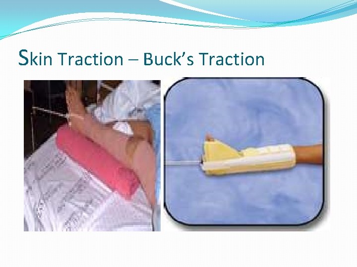 Skin Traction – Buck’s Traction 
