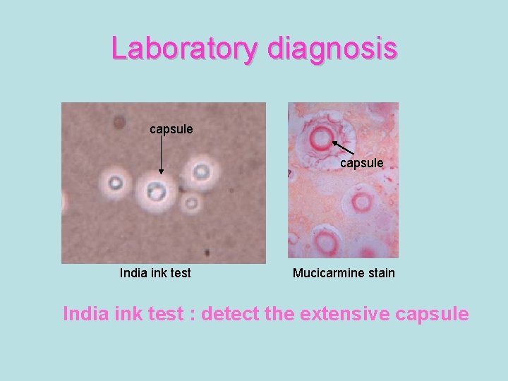Laboratory diagnosis capsule India ink test Mucicarmine stain India ink test : detect the