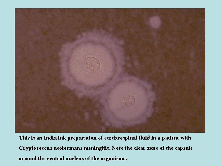 This is an India ink preparation of cerebrospinal fluid in a patient with Cryptococcus