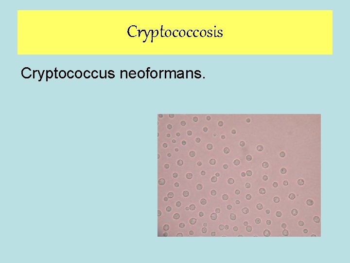 Cryptococcosis Cryptococcus neoformans. 