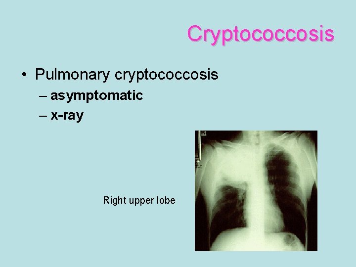 Cryptococcosis • Pulmonary cryptococcosis – asymptomatic – x-ray Right upper lobe 