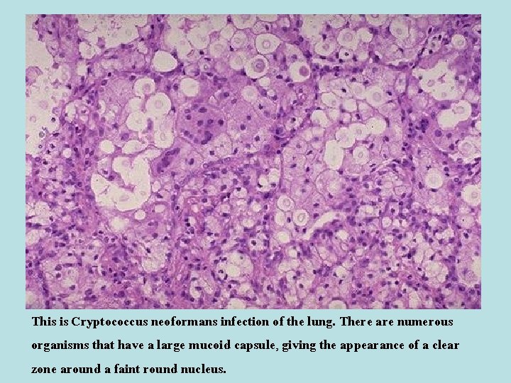 This is Cryptococcus neoformans infection of the lung. There are numerous organisms that have