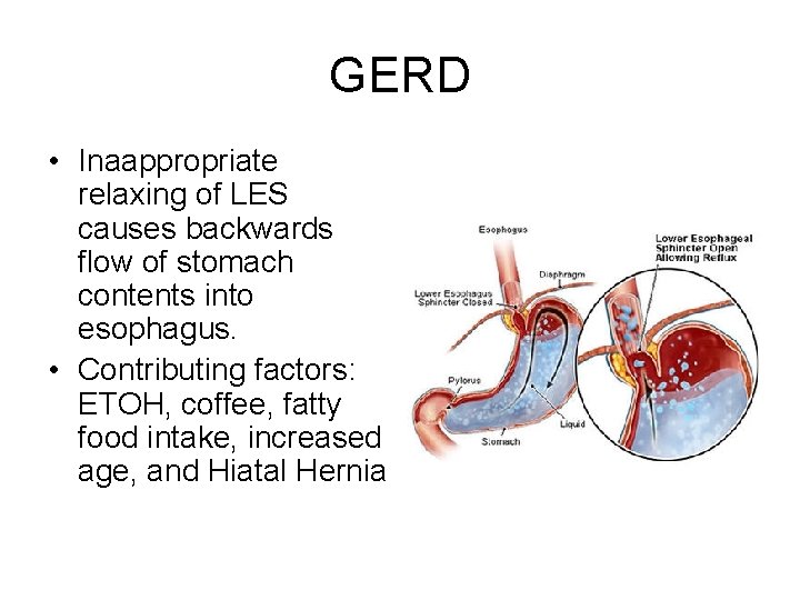 GERD • Inaappropriate relaxing of LES causes backwards flow of stomach contents into esophagus.