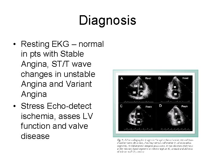 Diagnosis • Resting EKG – normal in pts with Stable Angina, ST/T wave changes