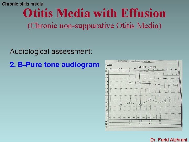 Chronic otitis media Otitis Media with Effusion (Chronic non-suppurative Otitis Media) Audiological assessment: 2.