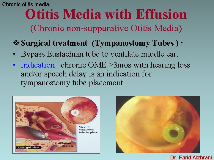 Chronic otitis media Otitis Media with Effusion (Chronic non-suppurative Otitis Media) v Surgical treatment