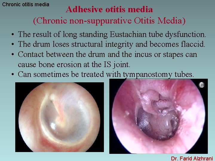Chronic otitis media Adhesive otitis media (Chronic non-suppurative Otitis Media) • The result of