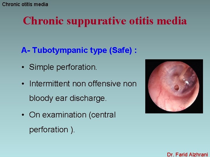 Chronic otitis media Chronic suppurative otitis media A- Tubotympanic type (Safe) : • Simple