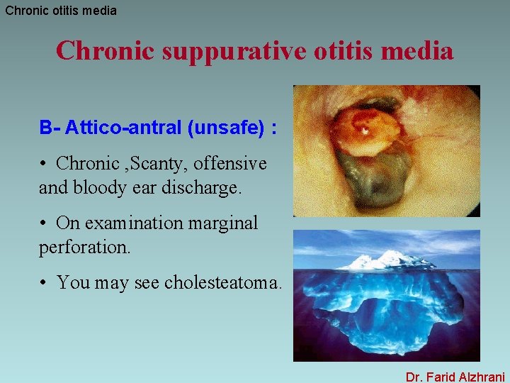 Chronic otitis media Chronic suppurative otitis media B- Attico-antral (unsafe) : • Chronic ,