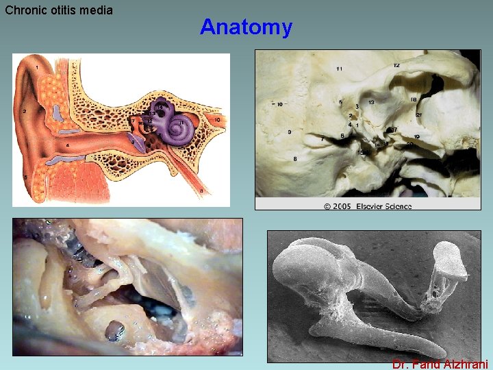 Chronic otitis media Anatomy Dr. Farid Alzhrani 