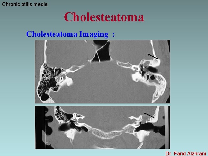 Chronic otitis media Cholesteatoma Imaging : Dr. Farid Alzhrani 