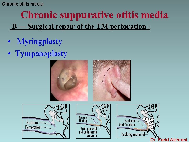 Chronic otitis media Chronic suppurative otitis media B — Surgical repair of the TM