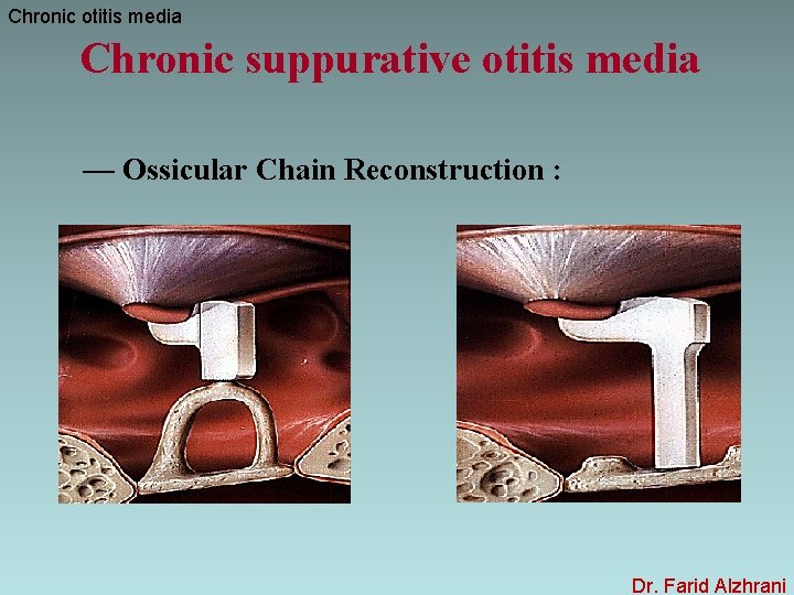 Chronic otitis media Chronic suppurative otitis media — Ossicular Chain Reconstruction : Dr. Farid