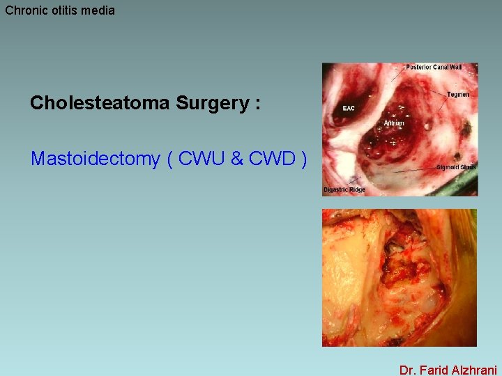 Chronic otitis media Cholesteatoma Surgery : Mastoidectomy ( CWU & CWD ) Dr. Farid