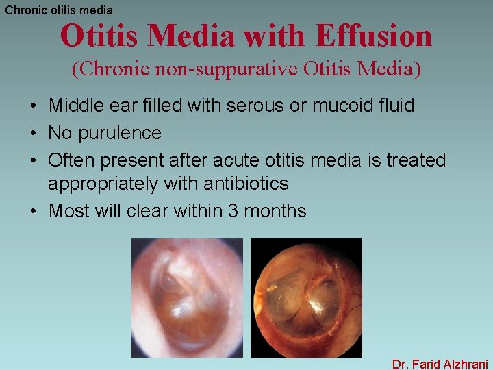 Chronic otitis media Otitis Media with Effusion (Chronic non-suppurative Otitis Media) • Middle ear