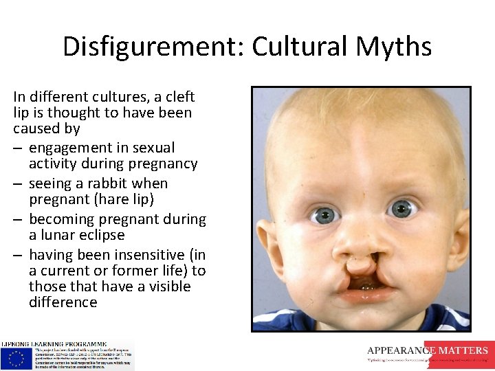 Disfigurement: Cultural Myths In different cultures, a cleft lip is thought to have been