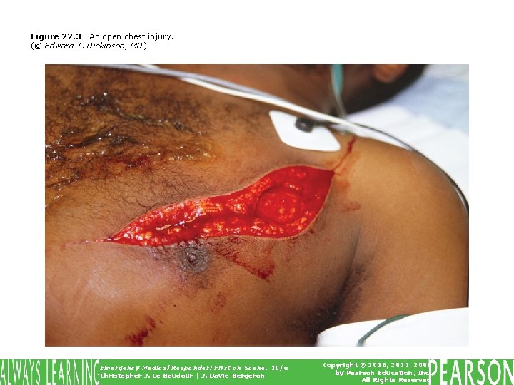 Figure 22. 3 An open chest injury. (© Edward T. Dickinson, MD) Emergency Medical