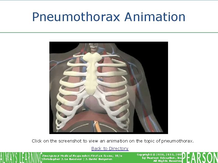 Pneumothorax Animation Click on the screenshot to view an animation on the topic of Pneumothorax Animation Click on the screenshot to view an animation on the topic of