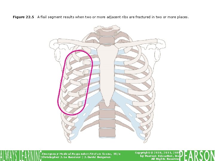 Figure 22. 5 A flail segment results when two or more adjacent ribs are